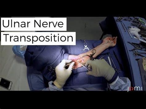 Ulnar Nerve Transposition (Links to Full Procedure) | Ulnar nerve, Nerve, Mind body