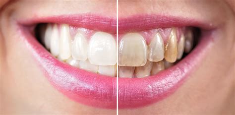 Teeth Whitening - 209 NYC Dental: Cosmetic Dentists