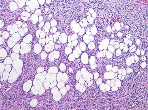 Dermatofibrosarcoma Protuberans | Radiology Key