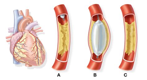 Balloon Angioplasty Linked to Fatal Neurological Events: Is It Really True?