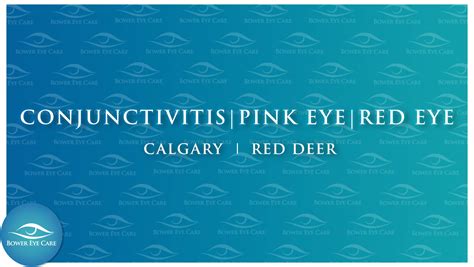 Eye Disease Management | Calgary | Red Deer | Conjunctivitis| Glaucoma
