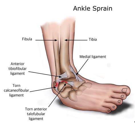 Ankle Sprains | Coreroanoke.com