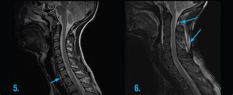 Adult MRI Series - Cervical spine: Trauma