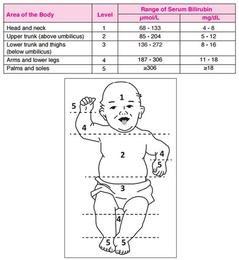 Visual Assessment of Neonatal Jaundice (Kramer’s rule) | Neonatal, Pediatric nursing, Neonatal ...