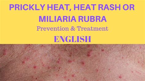 Prickly heat, heat rash or miliaria rubra | Prevention & treatment ...