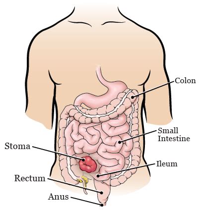 About Your Ileostomy Closure Surgery | Memorial Sloan Kettering Cancer ...