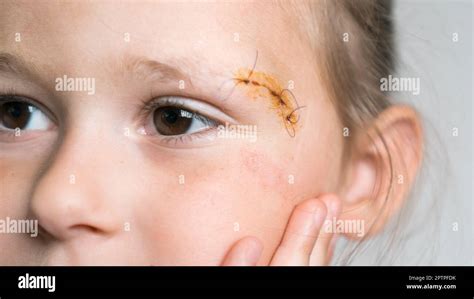 Close up sad, drear cropped cute girl face with stitches on scratch of eyebrow dissection ...