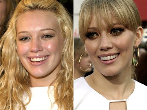 Celebrity Veneers | Celebrities with Veneers Before and After