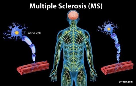 3 Most Common Nervous System Disorders - DIY Health | Do It Yourself ...