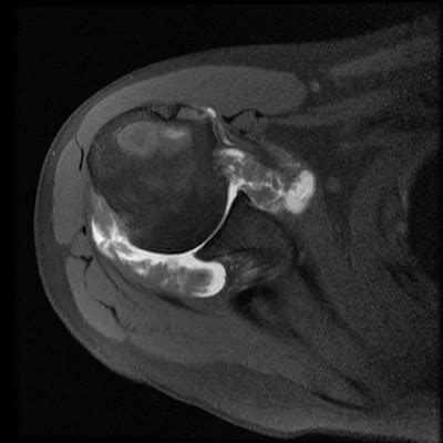 Radiology Cases: Rheumatoid Arthritis
