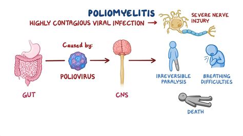 polio - Public Health Notes