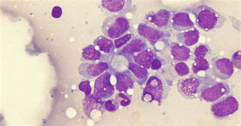 Ewing Sarcoma: Symptoms, Causes, Diagnosis, Treatment & Complications