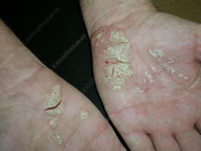 Palmar plantar psoriasis - Stock Image - C056/4946 - Science Photo Library