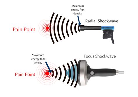 difference between Focus Shockwave therapy and Radial Shockwave Therapy ...