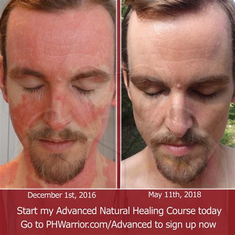 healing-before-after-face-psoriasis-2 - A Warrior Curing Psoriasis ...