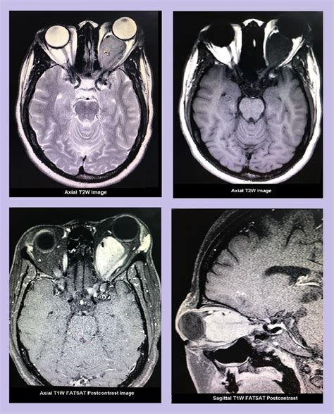 Optic Nerve Meningioma: Contrast enhanced MRI Brain and Orbit showed a ...