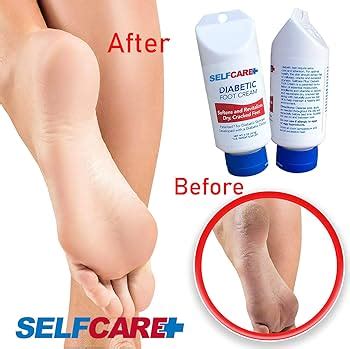 Fast Acting Diabetic Foot Patented 5oz Formulation | lupon.gov.ph