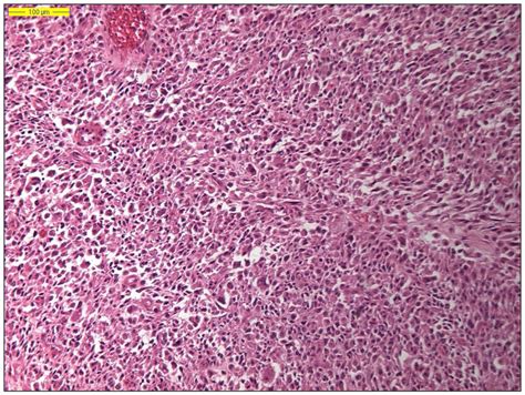 Histology of a dedifferentiated liposarcoma (hematoxylin and eosin ...