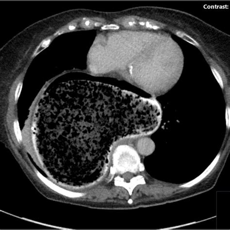 Image of OGD showing phytobezoar in the giant hiatus hernia | Download Scientific Diagram