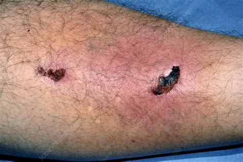 Cellulitis following leg injury - Stock Image - C028/4380 - Science Photo Library
