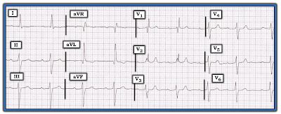 ECG Interpretation: ECG Blog #205 — What is Trifascicular Block?