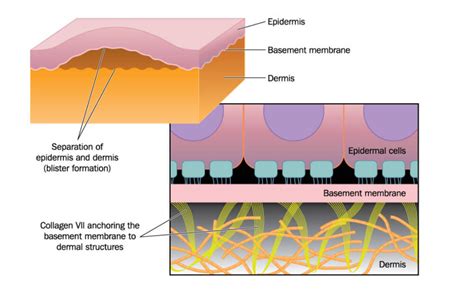 DIAGNOSIS AND TREATMENT OF EPIDERMOLYSIS BULLOSA