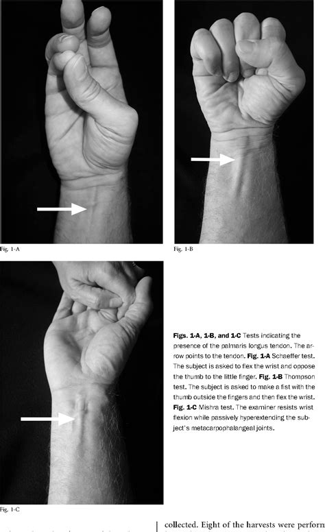 Figure 1 from Inadvertent Harvest of the Median Nerve Instead of the ...