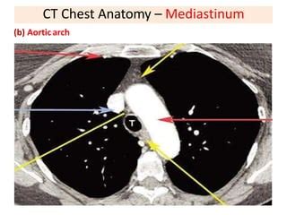 Basics of CT chest | PPT