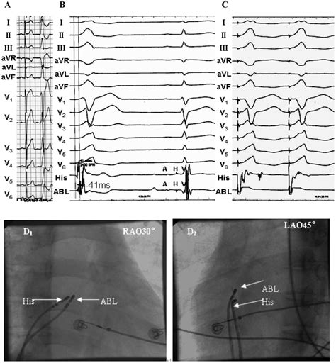 Example of a unsuccessful ablation of a premature ventricular... | Download Scientific Diagram