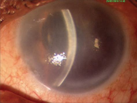 Edema - Causes, Flash Pulmonary, Corneal, Peripheral, Treatment