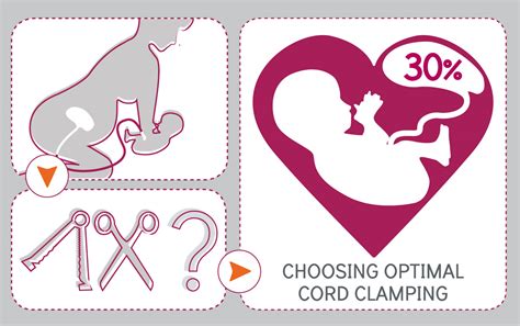 Choosing Optimal Cord Clamping - Birth Forward