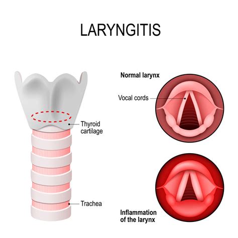 Chronic Laryngitis - Harvard Health