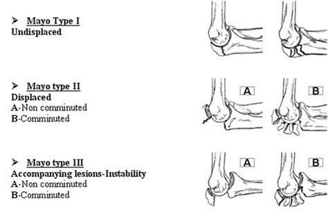 Olecranon Fracture - General Components and Differential Diagnosis of ...