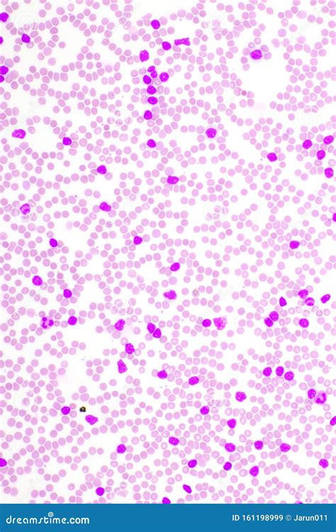 Picture of Leukemia Cells in Blood Smear Stock Image - Image of film, chronic: 161198999