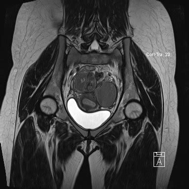 Pelvic Mri Procedure