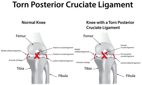 Posterior Cruciate Ligament (PCL) Injury - Symptoms - Treatment