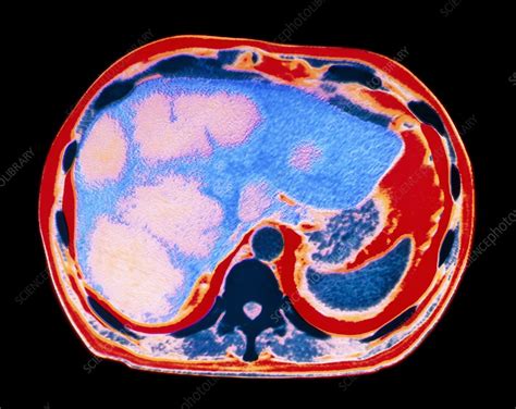 Coloured CT scan showing cancer of the liver - Stock Image - M134/0251 ...