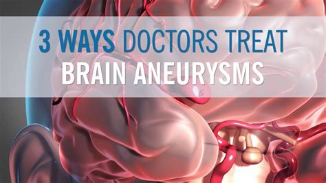 3 Ways Doctors Can Treat Your Brain Aneurysm - YouTube