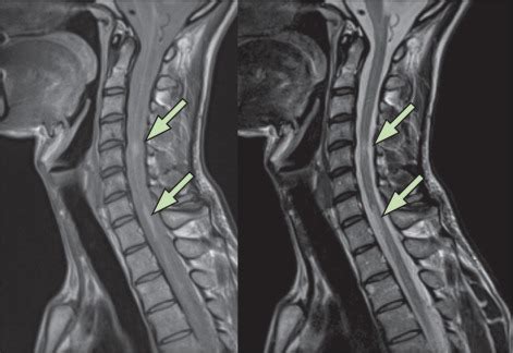 MRI criteria for the diagnosis of multiple sclerosis: MAGNIMS consensus guidelines - The Lancet ...