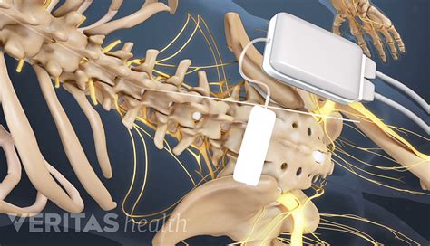 Sacroiliitis Surgery | Spine-health