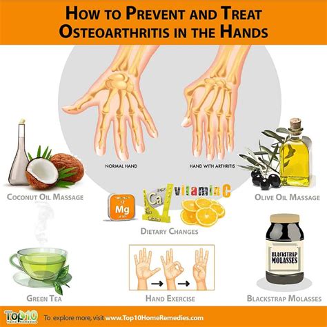 How to Prevent and Treat Osteoarthritis in the Hands | Top 10 Home Remedies | Osteoarthritis ...