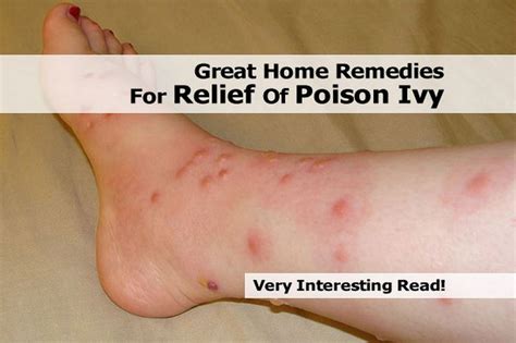 Great Home Remedies For Relief Of Poison Ivy