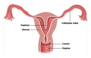 Uterine Septum Removal Found to Improve Fertility and Pregnancy Outcome - Austin Fertility ...