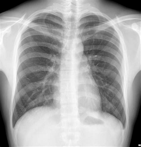 Chest X-Ray Interpretation in patients cough a week - Radiology Imaging