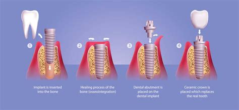 Dental Implants Side Effects - Tarzana Dentist | Victory Cosmetic Dentistry