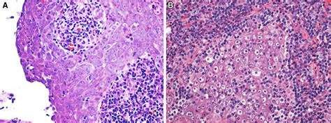 Nasopharyngeal Carcinoma Histology