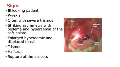 Tonsillitis, quinsy and adenoiditis