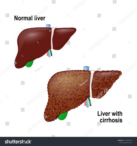 Normal Liver Liver Cirrhosis Cirrhosis Condition Stock Vector (Royalty ...