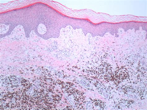 Malignant Melanoma Histology