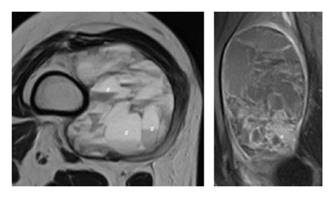 MRI characteristics of soft tissue sarcoma with telangiectatic changes... | Download Scientific ...